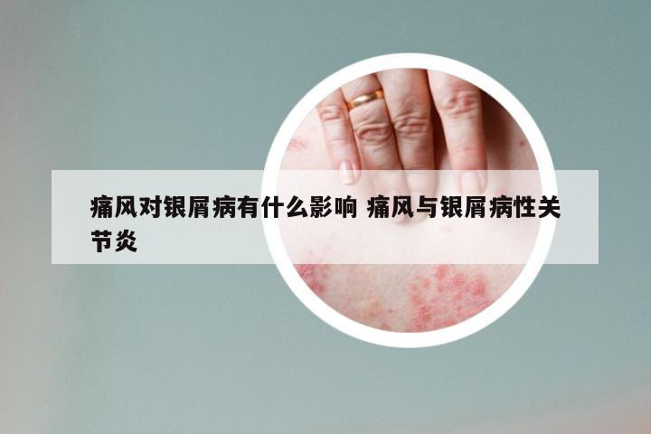 痛风对银屑病有什么影响 痛风与银屑病性关节炎