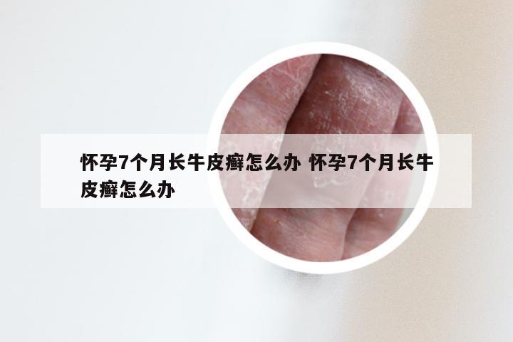 怀孕7个月长牛皮癣怎么办 怀孕7个月长牛皮癣怎么办