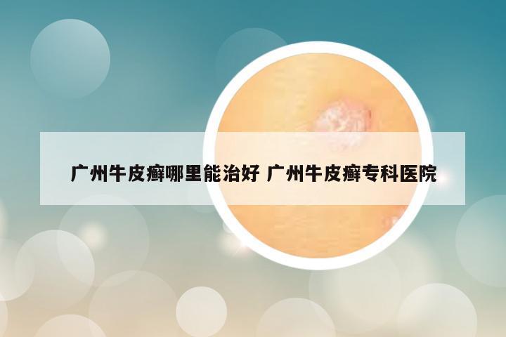广州牛皮癣哪里能治好 广州牛皮癣专科医院