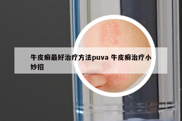 牛皮癣最好治疗方法puva 牛皮癣治疗小妙招