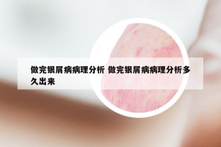 做完银屑病病理分析 做完银屑病病理分析多久出来