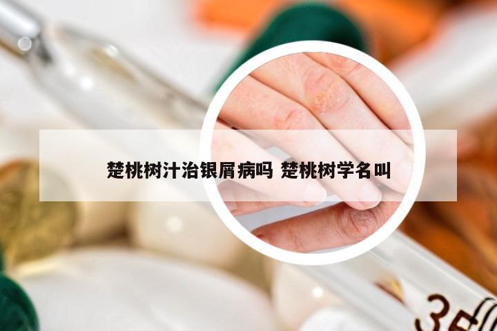 楚桃树汁治银屑病吗 楚桃树学名叫
