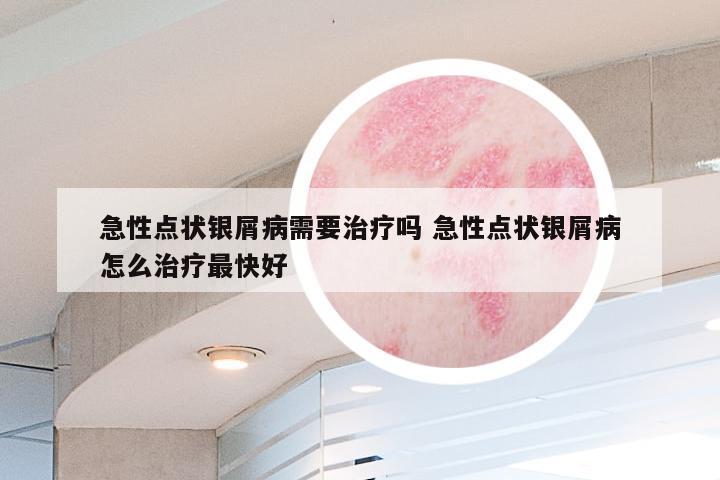 急性点状银屑病需要治疗吗 急性点状银屑病怎么治疗最快好