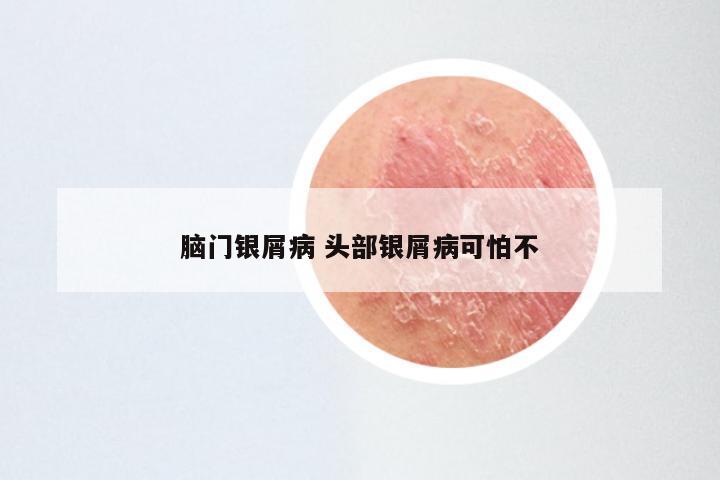 脑门银屑病 头部银屑病可怕不