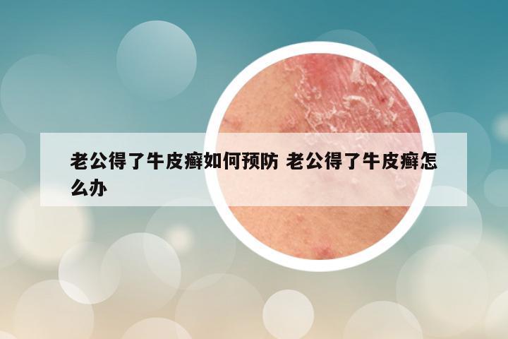 老公得了牛皮癣如何预防 老公得了牛皮癣怎么办