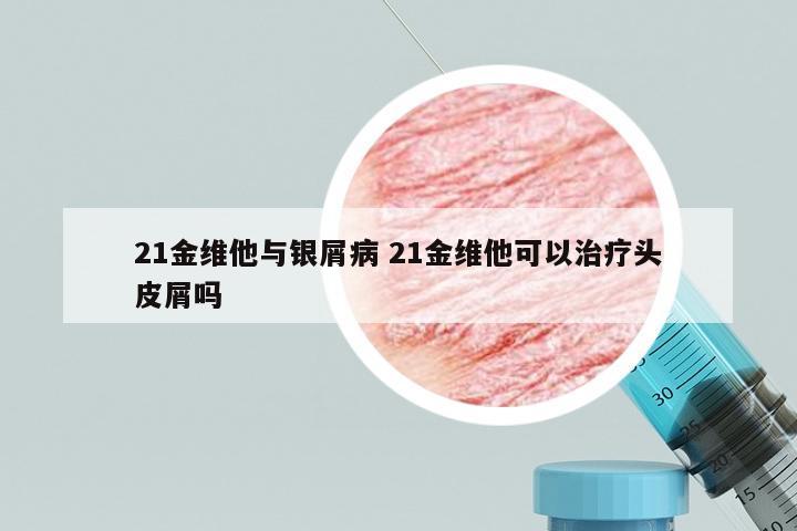 21金维他与银屑病 21金维他可以治疗头皮屑吗