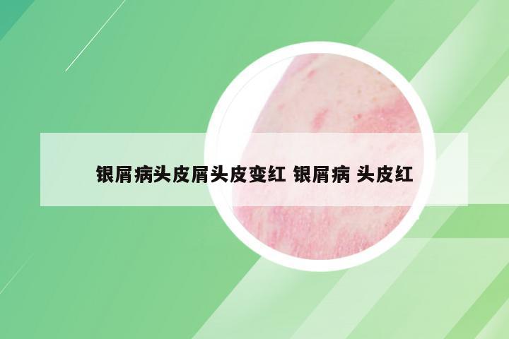银屑病头皮屑头皮变红 银屑病 头皮红
