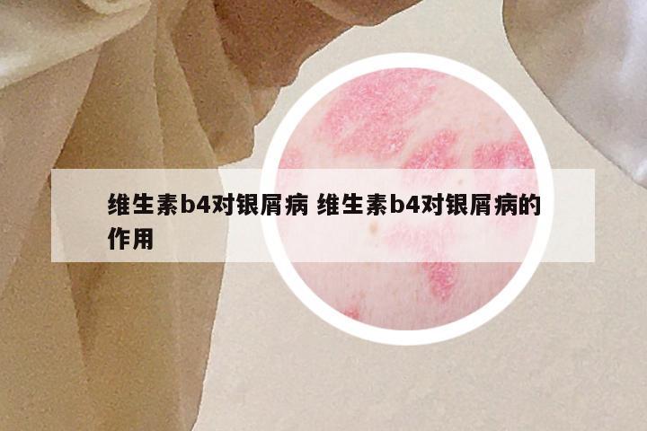 维生素b4对银屑病 维生素b4对银屑病的作用