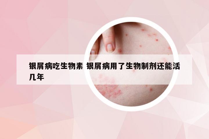 银屑病吃生物素 银屑病用了生物制剂还能活几年
