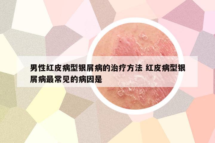 男性红皮病型银屑病的治疗方法 红皮病型银屑病最常见的病因是