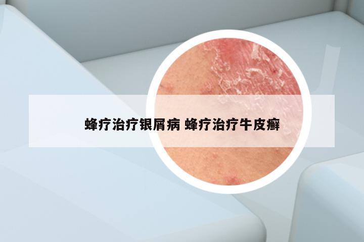 蜂疗治疗银屑病 蜂疗治疗牛皮癣