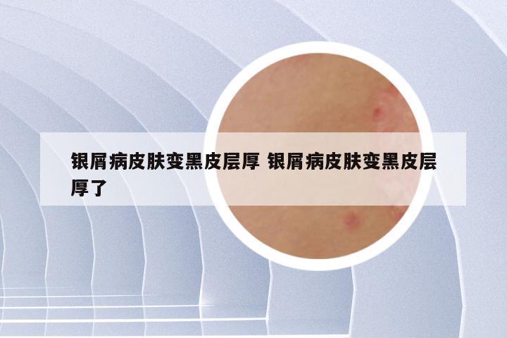 银屑病皮肤变黑皮层厚 银屑病皮肤变黑皮层厚了
