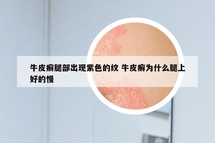 牛皮癣腿部出现紫色的纹 牛皮癣为什么腿上好的慢