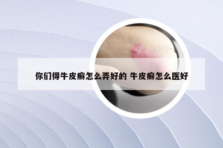 你们得牛皮癣怎么弄好的 牛皮癣怎么医好