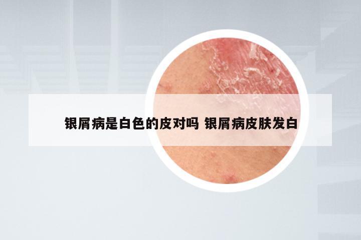 银屑病是白色的皮对吗 银屑病皮肤发白