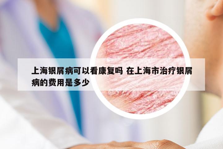 上海银屑病可以看康复吗 在上海市治疗银屑病的费用是多少