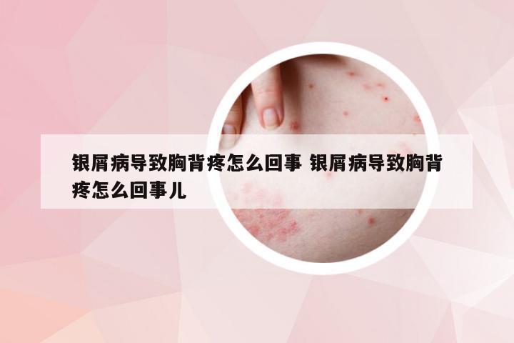 银屑病导致胸背疼怎么回事 银屑病导致胸背疼怎么回事儿
