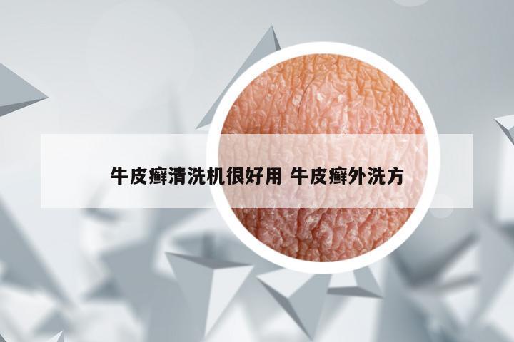 牛皮癣清洗机很好用 牛皮癣外洗方