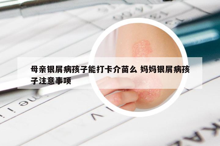 母亲银屑病孩子能打卡介苗么 妈妈银屑病孩子注意事项