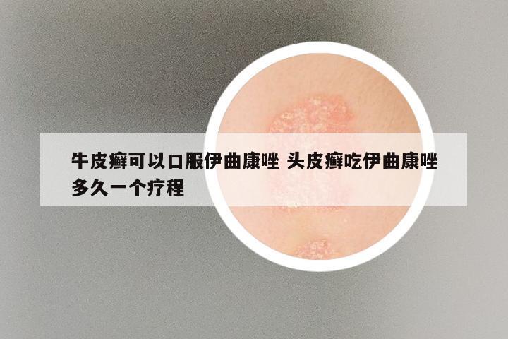 牛皮癣可以口服伊曲康唑 头皮癣吃伊曲康唑多久一个疗程