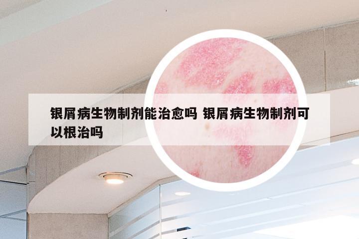 银屑病生物制剂能治愈吗 银屑病生物制剂可以根治吗