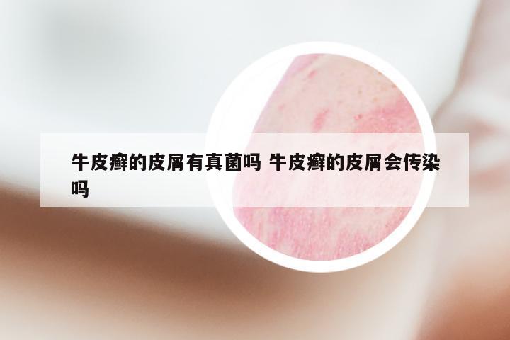 牛皮癣的皮屑有真菌吗 牛皮癣的皮屑会传染吗