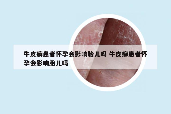 牛皮癣患者怀孕会影响胎儿吗 牛皮癣患者怀孕会影响胎儿吗