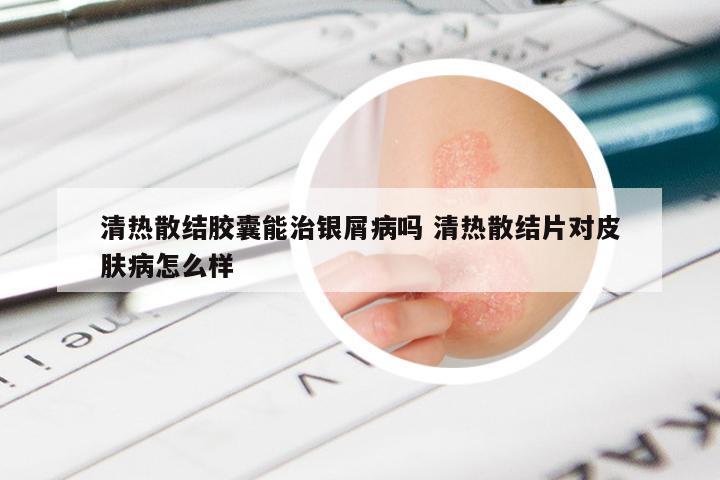 清热散结胶囊能治银屑病吗 清热散结片对皮肤病怎么样
