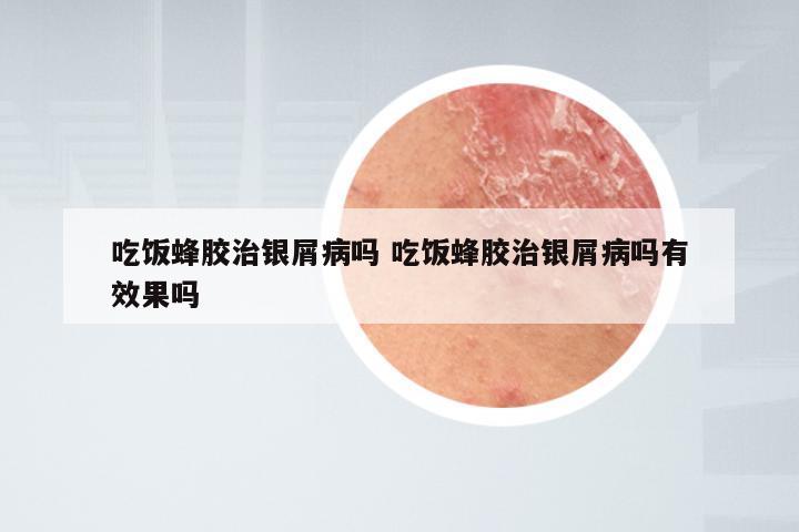 吃饭蜂胶治银屑病吗 吃饭蜂胶治银屑病吗有效果吗