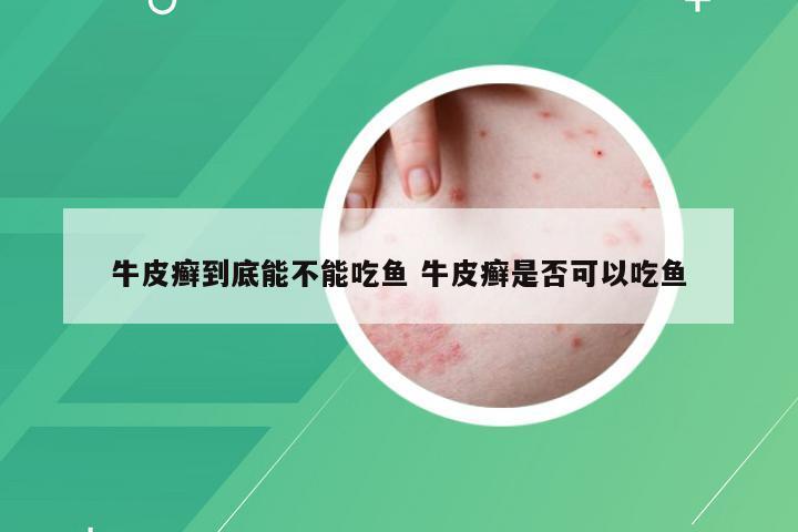 牛皮癣到底能不能吃鱼 牛皮癣是否可以吃鱼