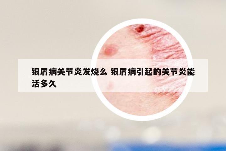 银屑病关节炎发烧么 银屑病引起的关节炎能活多久