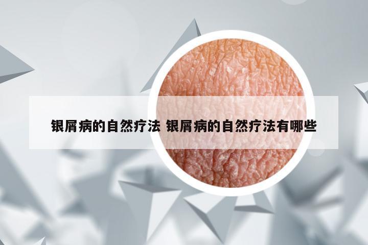 银屑病的自然疗法 银屑病的自然疗法有哪些