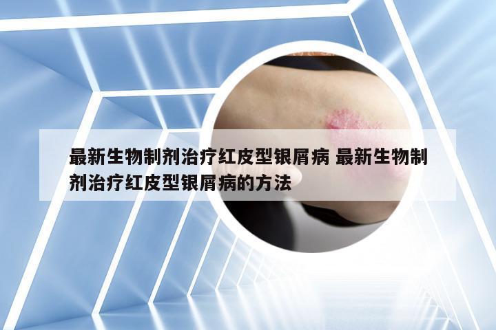 最新生物制剂治疗红皮型银屑病 最新生物制剂治疗红皮型银屑病的方法
