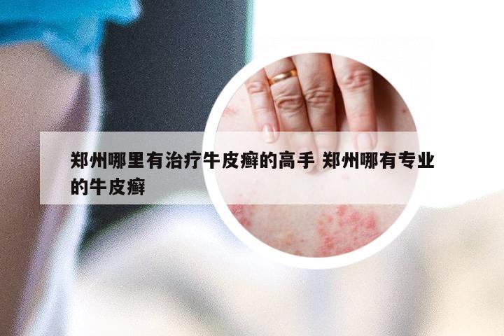 郑州哪里有治疗牛皮癣的高手 郑州哪有专业的牛皮癣