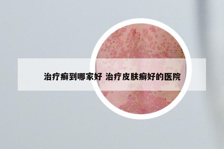治疗癣到哪家好 治疗皮肤癣好的医院