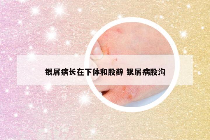 银屑病长在下体和股藓 银屑病股沟