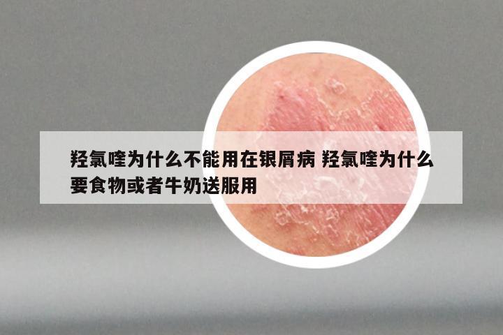 羟氯喹为什么不能用在银屑病 羟氯喹为什么要食物或者牛奶送服用