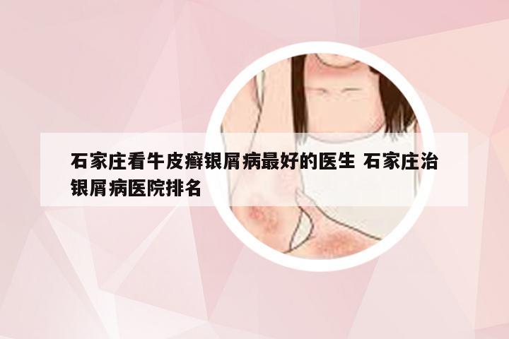 石家庄看牛皮癣银屑病最好的医生 石家庄治银屑病医院排名