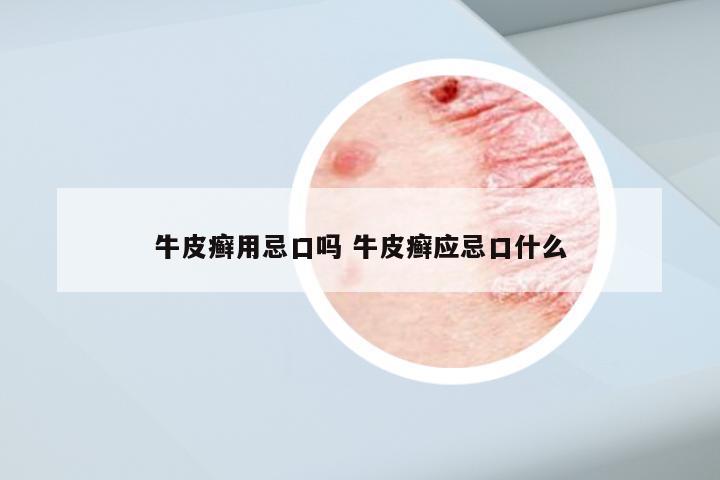 牛皮癣用忌口吗 牛皮癣应忌口什么
