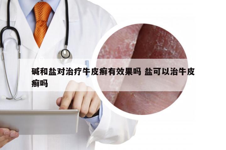 碱和盐对治疗牛皮癣有效果吗 盐可以治牛皮癣吗