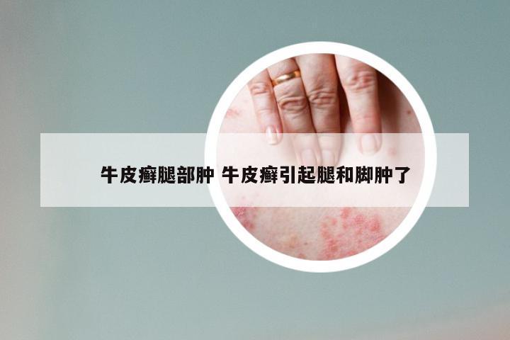 牛皮癣腿部肿 牛皮癣引起腿和脚肿了