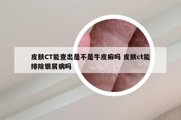 皮肤CT能查出是不是牛皮癣吗 皮肤ct能排除银屑病吗
