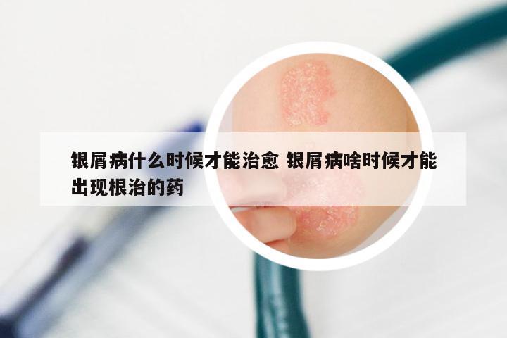 银屑病什么时候才能治愈 银屑病啥时候才能出现根治的药