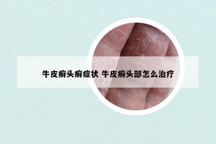 牛皮癣头癣症状 牛皮癣头部怎么治疗