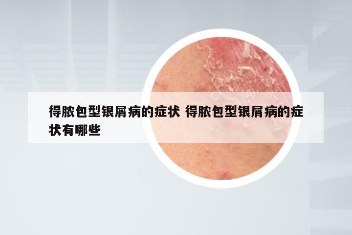 得脓包型银屑病的症状 得脓包型银屑病的症状有哪些