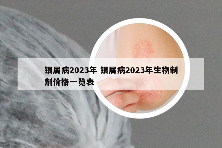 银屑病2023年 银屑病2023年生物制剂价格一览表