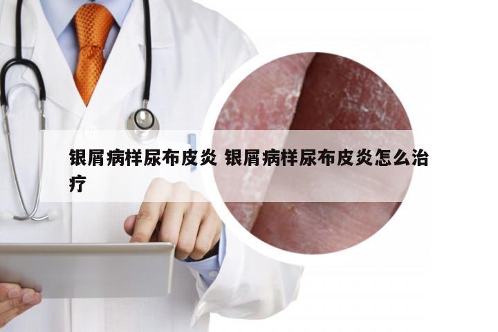银屑病样尿布皮炎 银屑病样尿布皮炎怎么治疗
