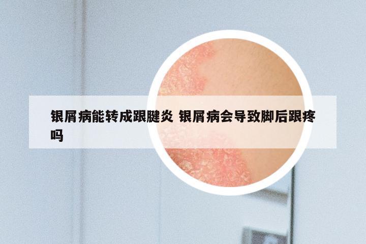 银屑病能转成跟腱炎 银屑病会导致脚后跟疼吗