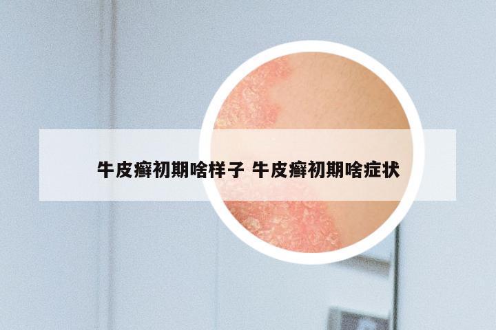 牛皮癣初期啥样子 牛皮癣初期啥症状