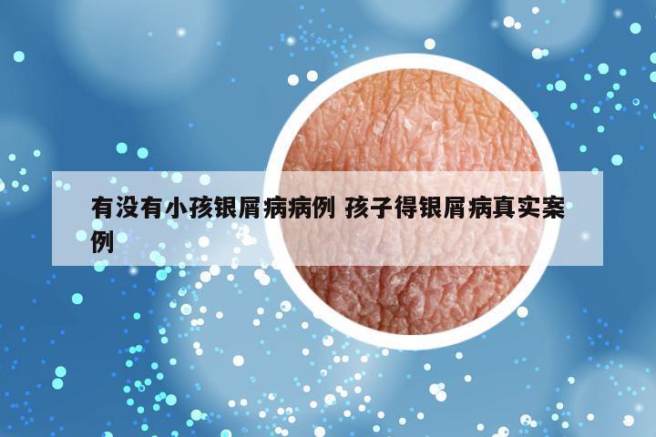 有没有小孩银屑病病例 孩子得银屑病真实案例